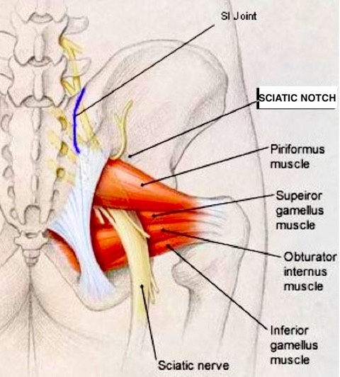 Syndrome du piriforme identifié comme sous-groupe de syndrome profond