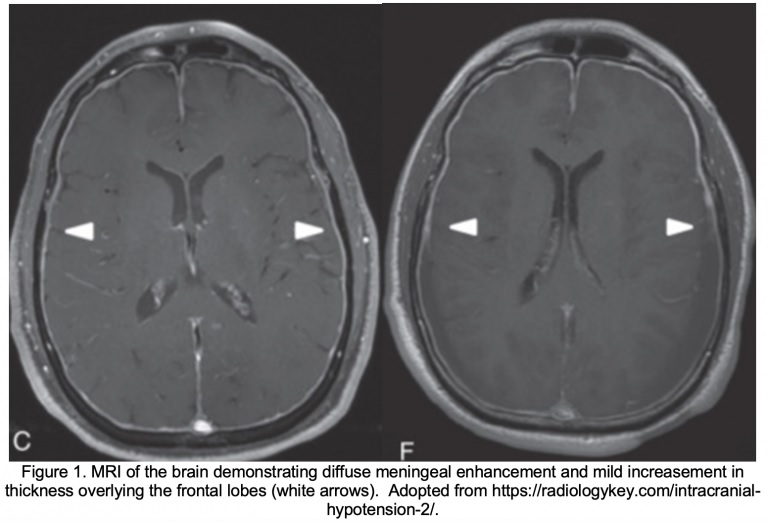 Hypotension intracrânienne spontanée