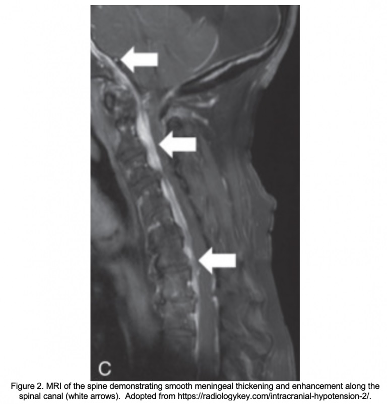 Hypotension intracrânienne spontanée