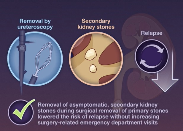 Élimination des petits calculs rénaux asymptomatiques et