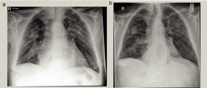 Pneumoconiose&nbsp;: caractéristiques cliniques et thérapie