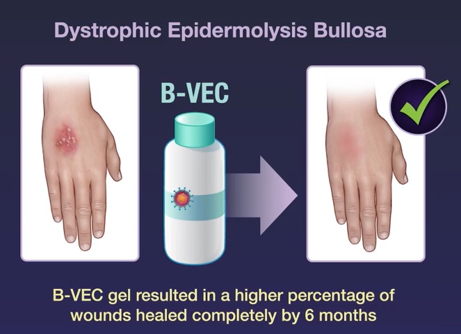 Thérapie génique topique pour l’épidermolyse dystrophique