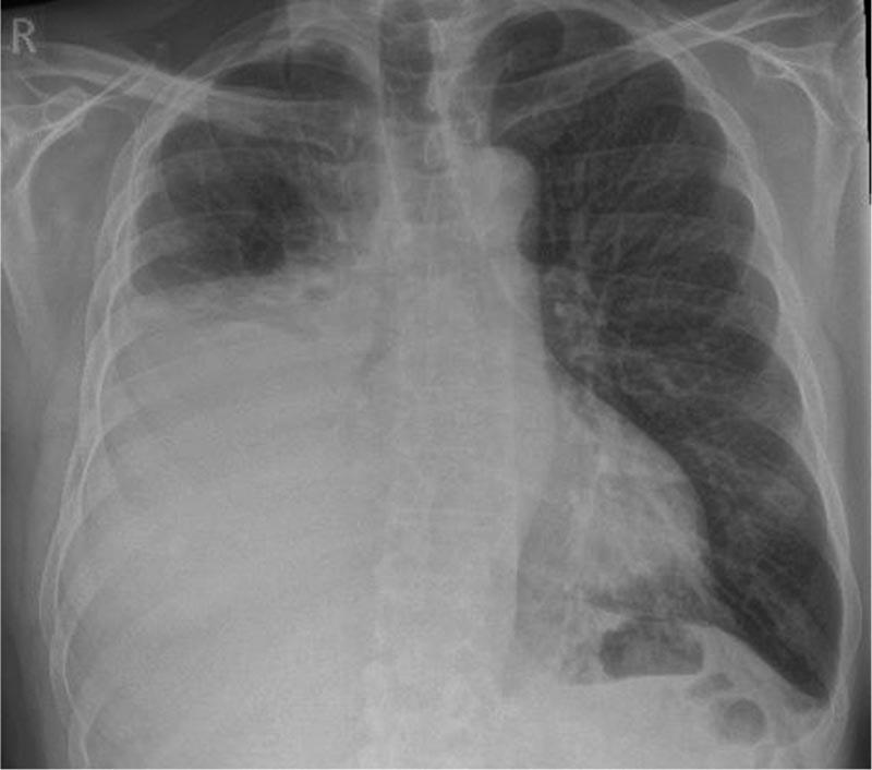 Épanchement pleural unilatéral&nbsp;: examen clinique et C