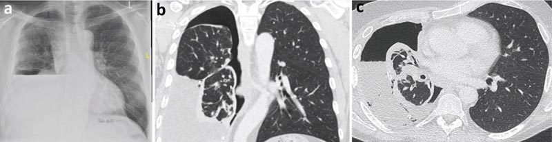 Épanchement pleural unilatéral&nbsp;: examen clinique et C