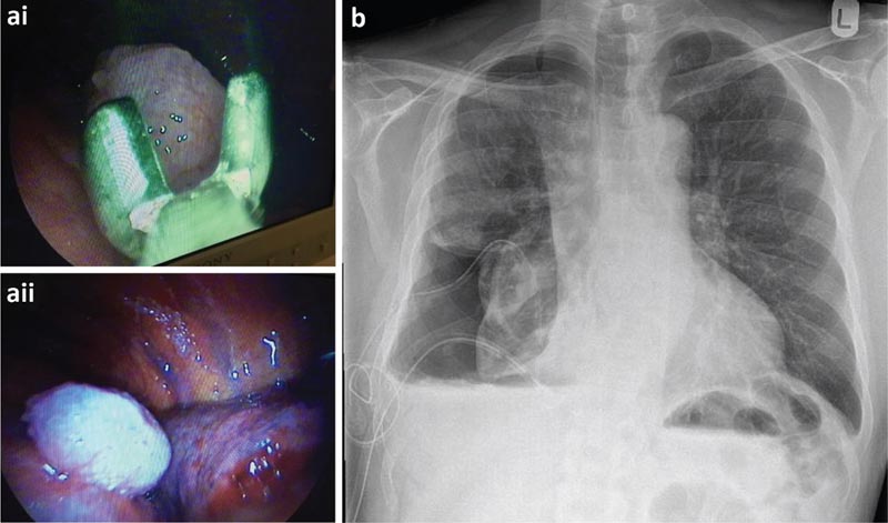 Épanchement pleural unilatéral&nbsp;: examen clinique et C