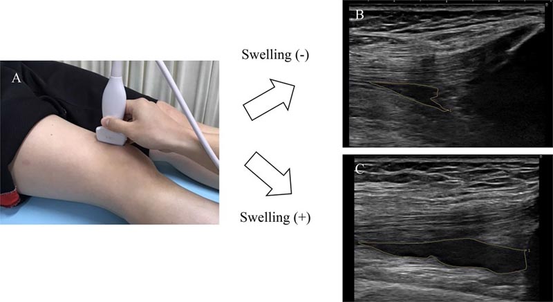 Inflammation subjective du genou dans l’arthrose du genou