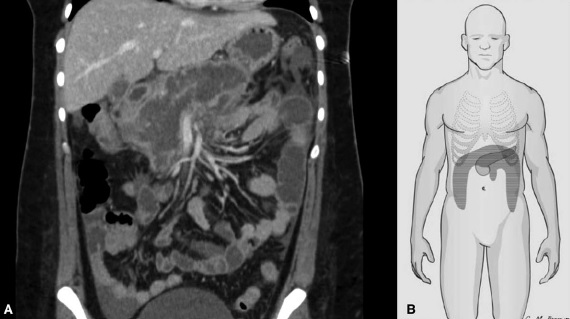 Implication du côlon dans la pancréatite nécrosante&nbsp;: Inc