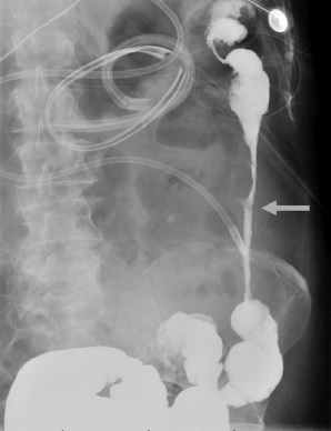 Implication du côlon dans la pancréatite nécrosante&nbsp;: Inc