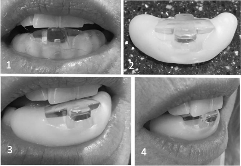 Serrements nocturnes de la mâchoire liés à la migraine
