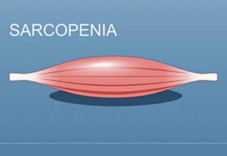 Defining Sarcopenia