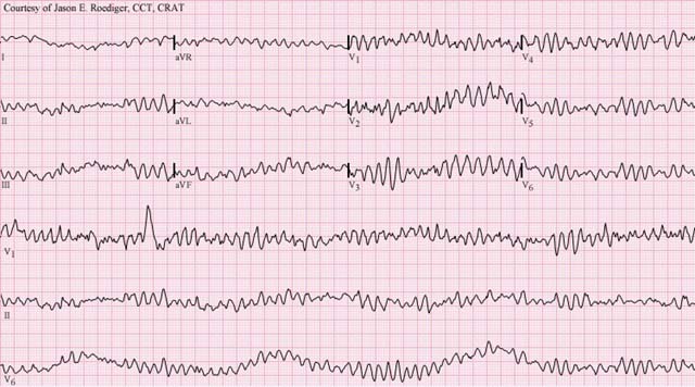Commotio Cordis